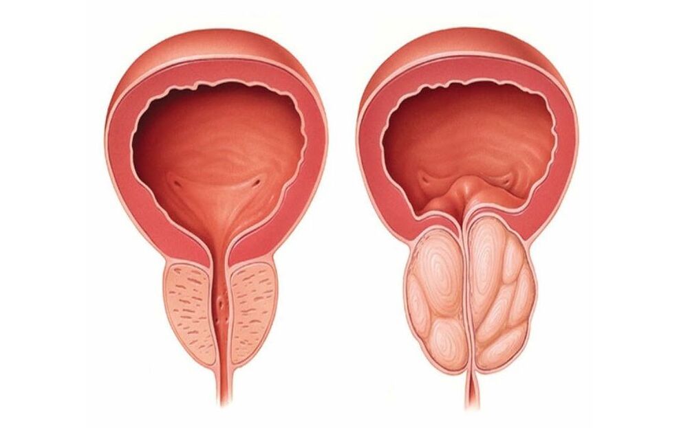 normal an entzündegt Prostata