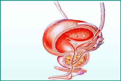 Entzündung vun der Prostata bei akuter Prostatitis ass eng Begrenzung fir Sex