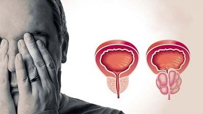 D'Grënn fir d'Entwécklung vu Prostatitis op Männer