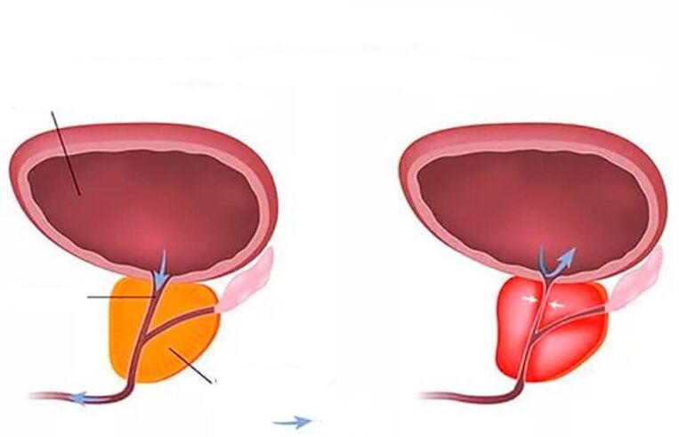 normal an entzündegt Prostata