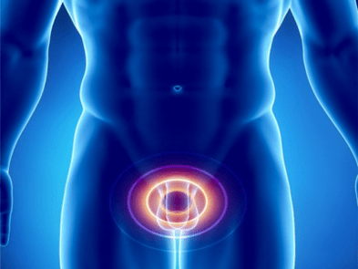 Prostatitis – Entzündung vun der Prostata Drüs bei engem Mann