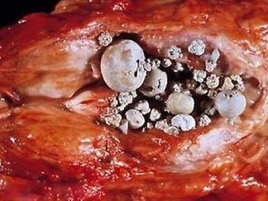 Steng an der Prostata mat berechentem Prostatitis