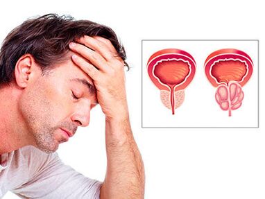 Symptomer vun Prostatitis Suergen e Mann