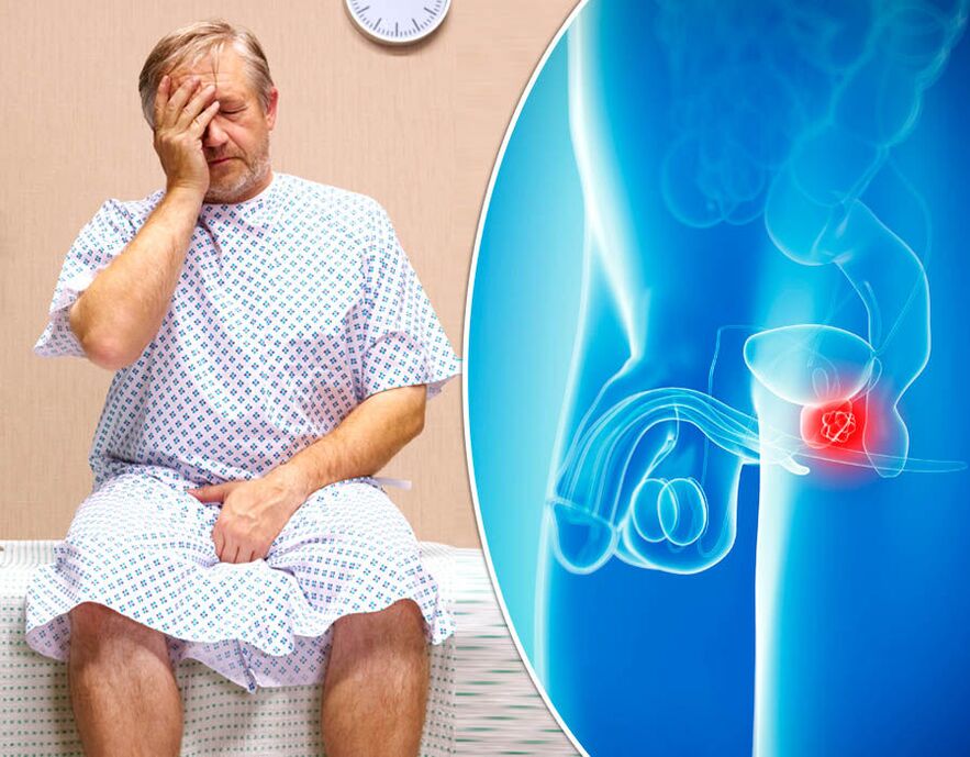 E Mann mat Prostatitis gëtt mat enger Krankheet diagnostizéiert