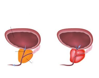 Normal an entzündegt Prostata
